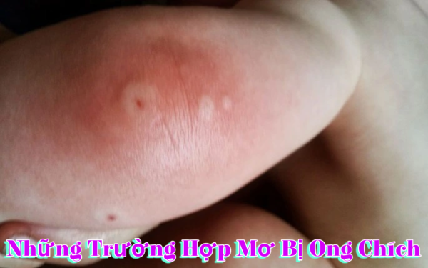 Mơ thấy bị ong chích vào cổ